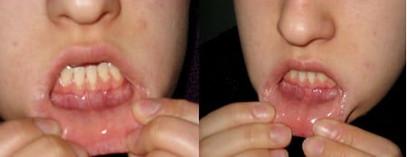 Короткая уздечка нижней губы (до и после пластики)