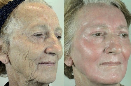 На фото хорошо заметны изменения кожи лица после химического пилинга 