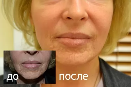До и после лазерной шлифовки рубцов До и после лазерной шлифовки рубцов