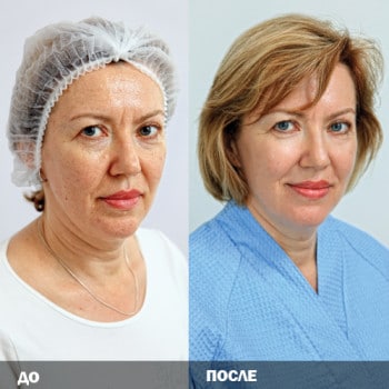 До и после процедуры лазерного омоложения лица