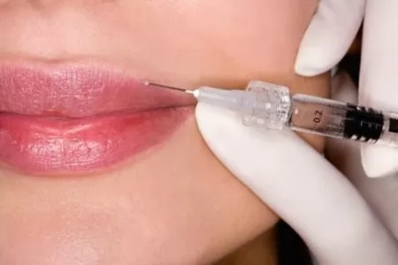 Введение геля для увеличения губ Введение геля для увеличения губ