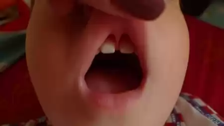 Диастема верхней губы