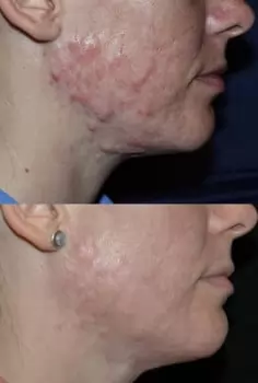 Шлифовка рубцов Удаление с кожи лица рубцов